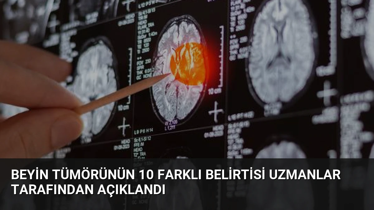 Beyin Tümörünün 10 Farklı Belirtisi Uzmanlar Tarafından Açıklandı