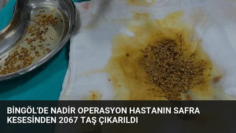 Bingöl’de Nadir Operasyon Hastanın Safra Kesesinden 2067 Taş Çıkarıldı