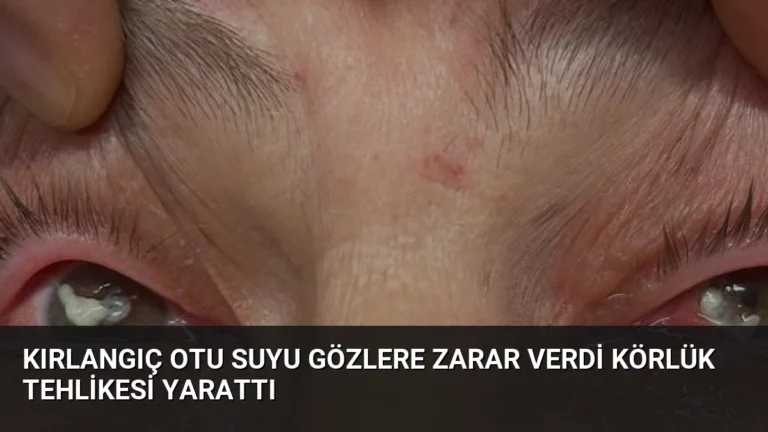 Kırlangıç Otu Suyu Gözlere Zarar Verdi Körlük Tehlikesi Yarattı