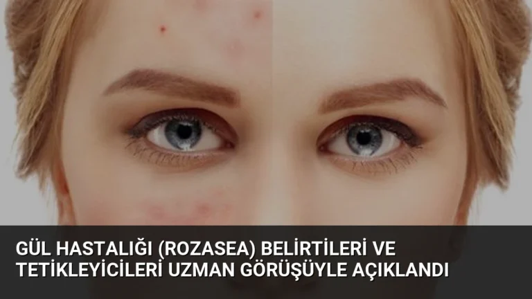 Gül Hastalığı (Rozasea) Belirtileri ve Tetikleyicileri Uzman Görüşüyle Açıklandı