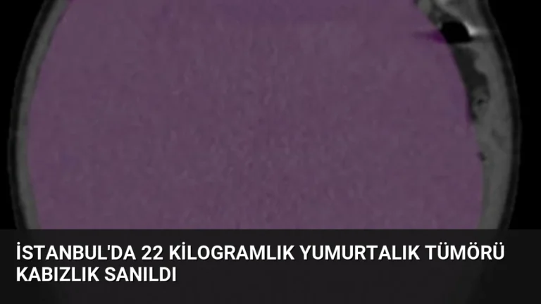 İstanbul’da 22 Kilogramlık Yumurtalık Tümörü Kabızlık Sanıldı